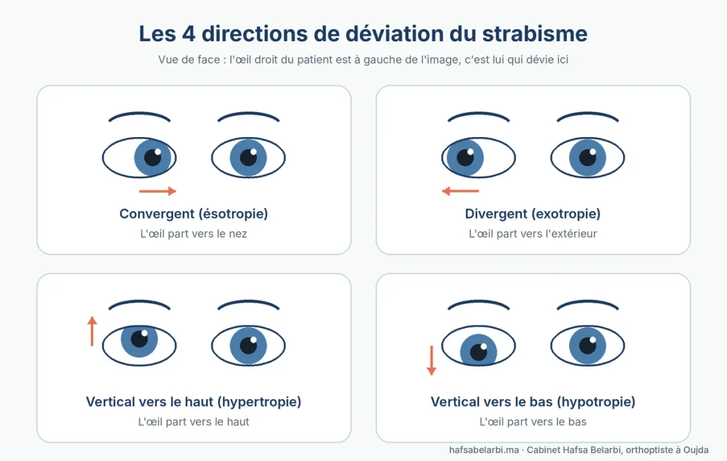 Les quatre directions de déviation du strabisme : convergent, divergent, vers le haut et vers le bas